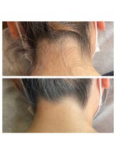 プルメリア(Plumeria)/うなじ脱毛