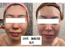 チャマ 徳島本店(CHAMA)/20代　ララピール　施術2回　