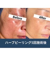 エルア 尼崎(Elua)/肌のトーンが爆上がり！