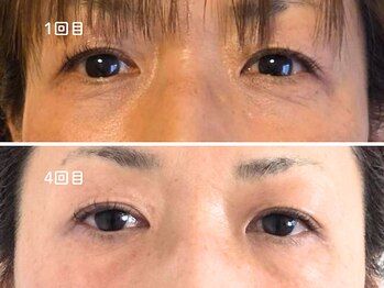 オラ(Ola)/40代/施術4回目