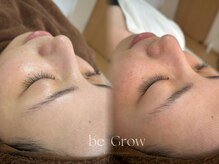 ビーグロウ(be Grow)/白玉ピーリングbeforeafter