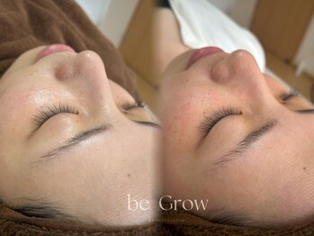 ビーグロウ(be Grow)/白玉ピーリングbeforeafter