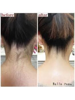 シュウ/うなじ脱毛