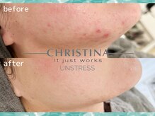 ザ サロン アリア 池袋(THE SALON aria)/クリスティーナで肌荒れ改善