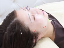 アキュモンド 渋谷院(acumond)/美容鍼首肩こり改善コース施術中
