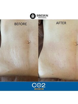 ウィズリリナ 新横浜(with Lilina.)/1回/カーボキシー/炭酸パック