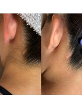 サロン ルポ 高槻(Salon Repo)/【ダブル脱毛】うなじ