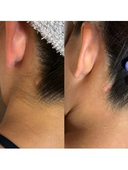 サロン ルポ 高槻(Salon Repo)/【ダブル脱毛】うなじ