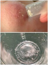 モイ(moi.)&nbsp;肌根本改善 毛穴洗浄