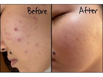 エムエスアイ(MSI)の写真/【美肌光フェイシャル】ニキビ、毛穴、くすみ、ハリ、まとめてアプローチ^_^