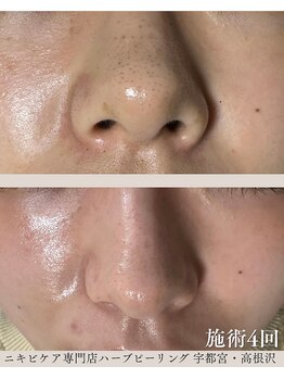 ハーブピーリングHYの写真/理想の毛穴レス肌へ☆ハーブピーリングでニキビケア！結果重視の施術で自信UP♪