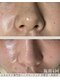 ハーブピーリングHYの写真/理想の毛穴レス肌へ☆ハーブピーリングでニキビケア！結果重視の施術で自信UP♪