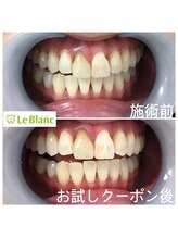 ルブラン 奈良店(Le Blanc)/歯が綺麗だと。。。