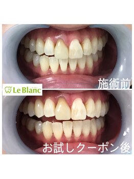 ルブラン 奈良店(Le Blanc)/歯が綺麗だと。。。