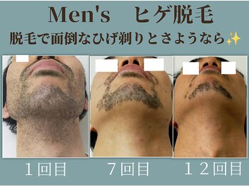 ラーナ(Lana)/ヒゲ脱毛　before→after