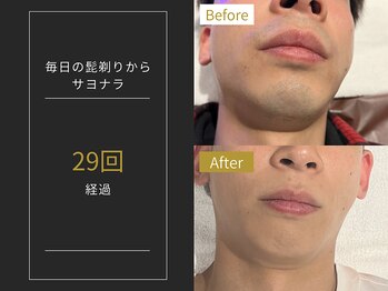 ステイゴールド 新百合ヶ丘(STAY GOLD)/おヒゲ脱毛の経過☆