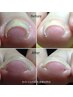 人気1位【巻き爪専門】初めての巻き爪補整 1ヵ所☆¥10300～¥12000 ⇒¥9000