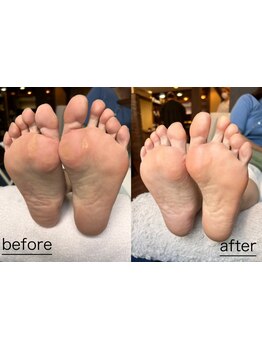 角質ケアができるサロン