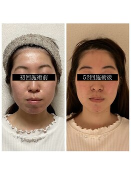 キュープ 静岡店(Qpu)/小顔矯正+美肌美顔器モニター