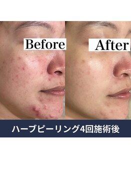 エルア 尼崎(Elua)/何をしても改善しなかったニキビ