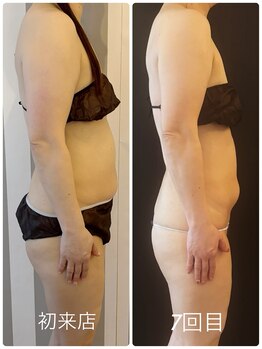 ルーシーガーデン(LUCY GARDEN)/インディバ.よもぎ蒸し/週1×7