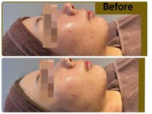 人気沸騰中ニキビ、しみ、シワ、毛穴、プラズマが解決