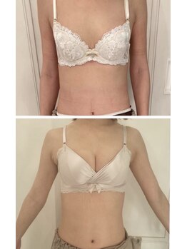 美人バスト 南森町店/バストアップ◇症例◇