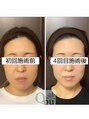 小顔矯正専門サロン キュープ 茨城つくば店(Qpu)&nbsp;小顔矯正 美顔器