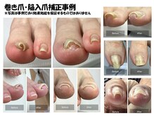 小山巻き爪センターの雰囲気（巻き爪・陥入爪補正事例[足の指・手の指・切りすぎた爪対応可能]）