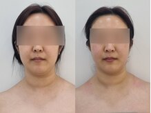 チョンダムビューティー(chondam beauty)/1回の施術でもこんな小顔に！！