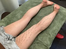 上野毛駅前整骨院 鍼灸院/足のだるさへの鍼