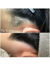 ディア(Dea)/襟足・うなじ WAX脱毛