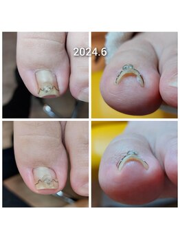 爪切り屋 足楽/巻いた爪のリフト★