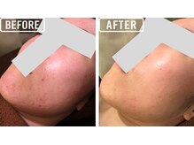 ビビ(VIVI)/ララピール症例・肌質改善