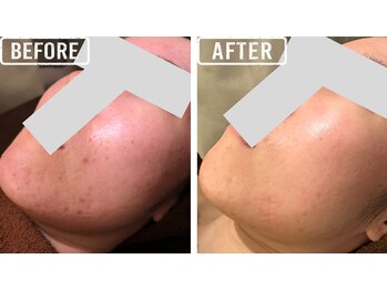 ビビ(VIVI)/ララピール症例・肌質改善