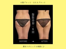 ブルースター 上小田井店(Blue Star)/脂肪冷却２４カップ×６回