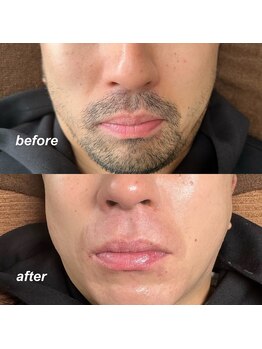 咲/ヒゲWAXと光脱毛