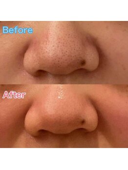 ベルローズ ラパーク 金沢店/フェイシャルビフォーアフター