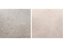 ピービー(PB)/ハーブピーリング