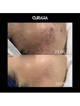 パールブルー(All Perl blue)/キュラハのエステ