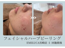 エミルカ 宮崎店(EMILUCA)の雰囲気（美容液もエレクトロポレーションで奥深く導入するスペシャルケア）