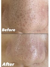 エステモ 札幌店(ESTEMO)/ディープクレンジング毛穴洗浄♪