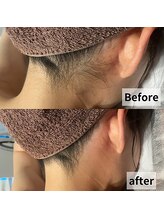 セイリキ(SEIRIKI)/うなじ脱毛