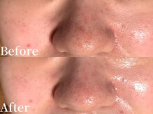 プレジール(plasir)/毛穴洗浄×ハーブピーリング！