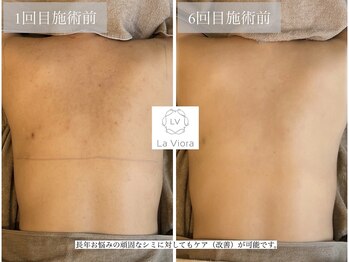 ラヴィオーラ 加古川店(La Viora)/ダイヤモンドハーブピーリング