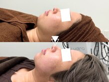 【フェイスラインのもたつき/小顔になりたい方必見】【韓国で人気の最先端小顔施術】マイクロリフト13000円