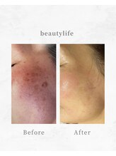 ビューティーライフ(beauty life)/シミ消しゴムやり放題