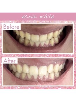 エクシアホワイトニング 武蔵小杉店/ビフォーアフター