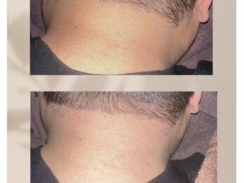 サン(Sun)/首、肩、頭を集中施術