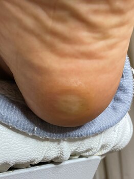 フットメンテ 巻き爪矯正センター 南浦和/踵に出来たタコ